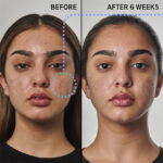 شوینده ضد جوش 5% بنزوئیل پروکساید سوپر سولوشن اینکی لیست - تصویر 3