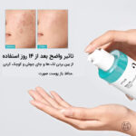 تونر لایه بردار و کنترل کننده منافذ آنوا - تصویر 2